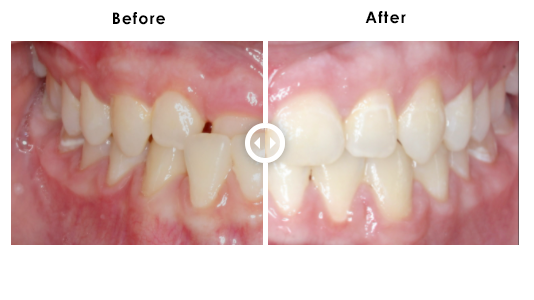 904DentalCare-Ortho_Before_After3