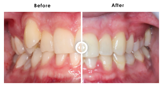 904DentalCare-Ortho_Before_After4