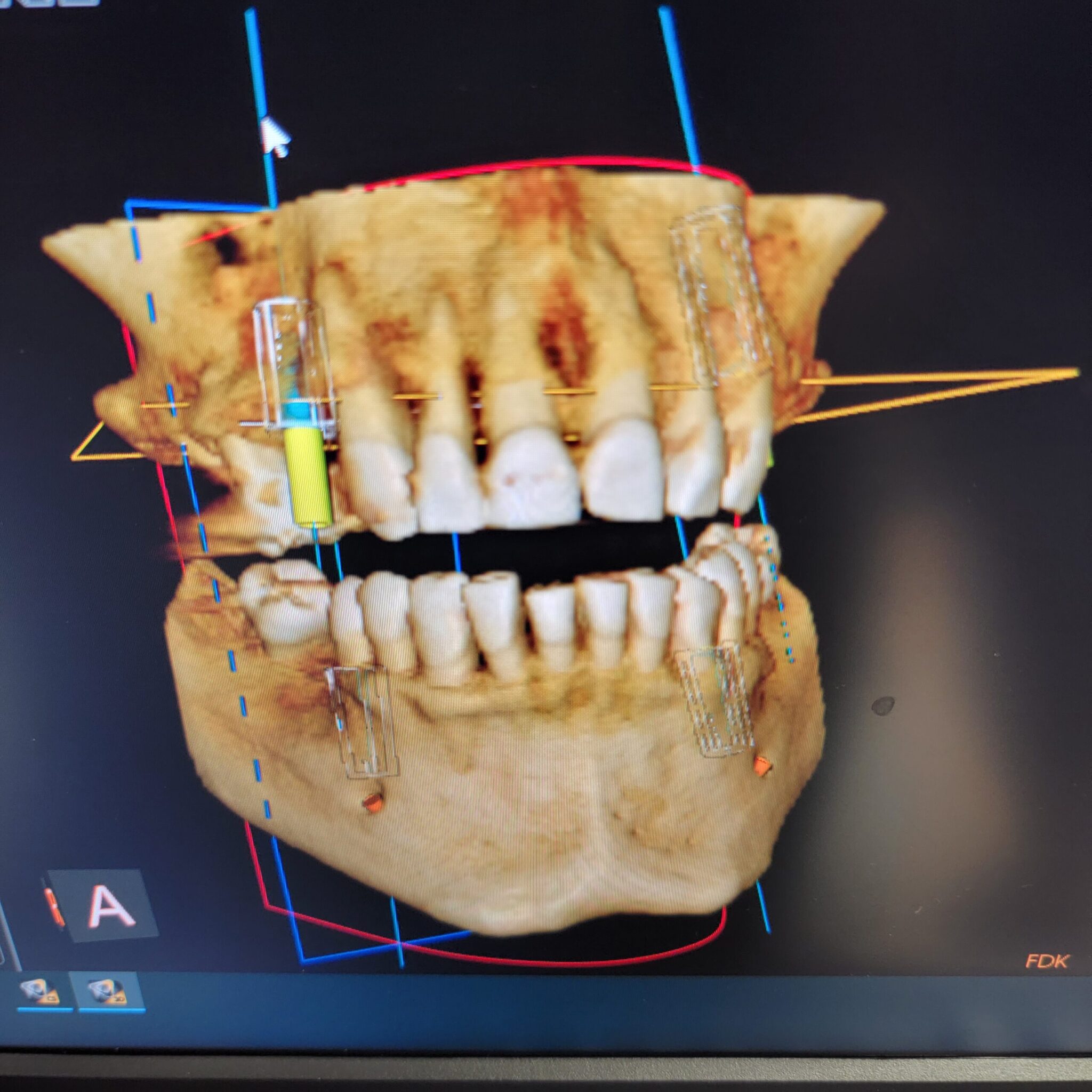 3D Digital image of teeth and jaws with implants at 904 Dental Care